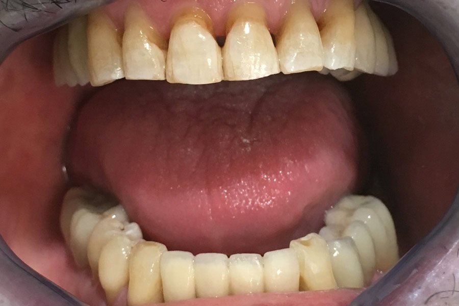 Implantes dentales, después de la colocación