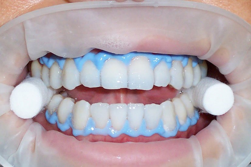 Blanqueamiento dental en clínica