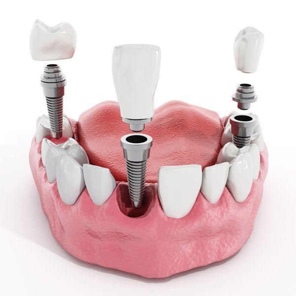 Osteointegración, tiempo y tipo de implante dental