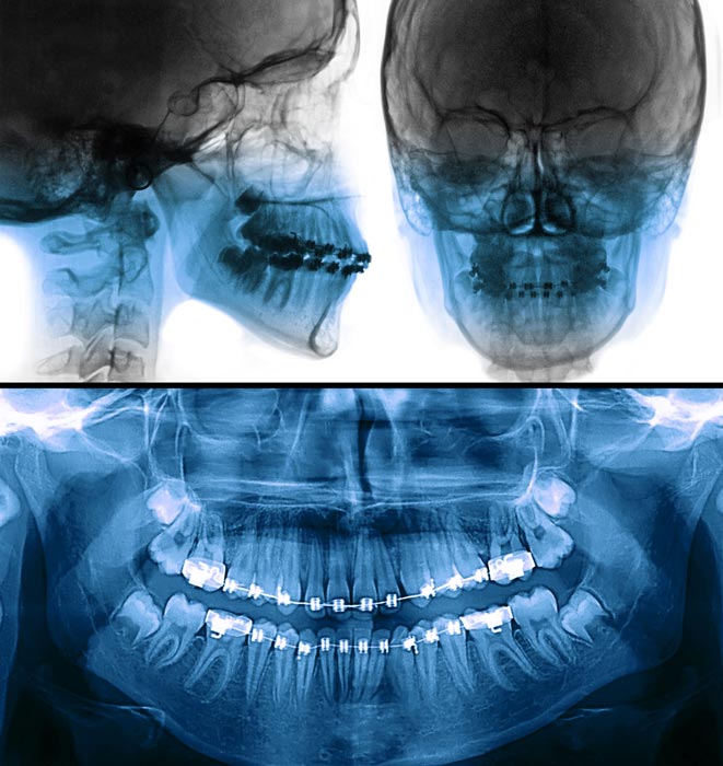 Tratamiento de ortodoncia: estudio