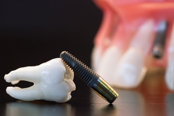 Implantes dentales en pacientes fumadores