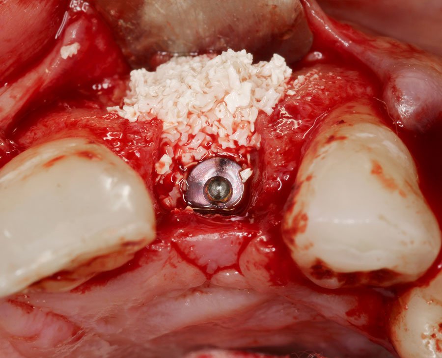 Colocación de un implante dental