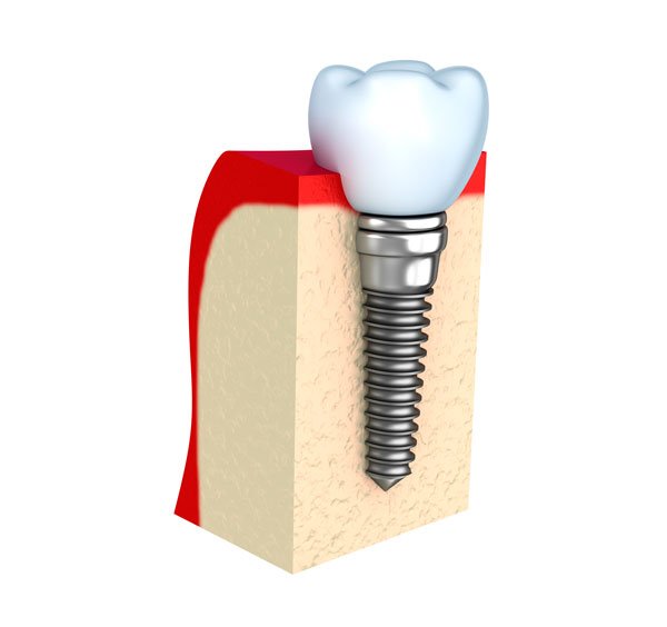 Cuidados de los implantes dentales