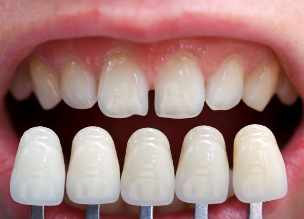Carillas dentales para eliminar las manchas en los dientes