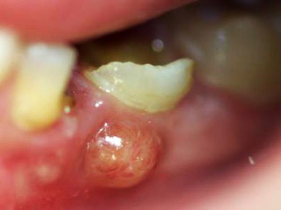¿Qué es el flemón dental en niños?