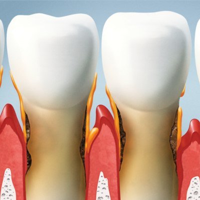 causas pérdida hueso dental