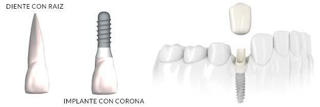 Implante dental y corona