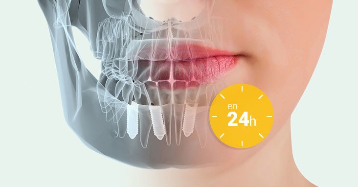 Implantes dentales de carga inmediata: tiempo