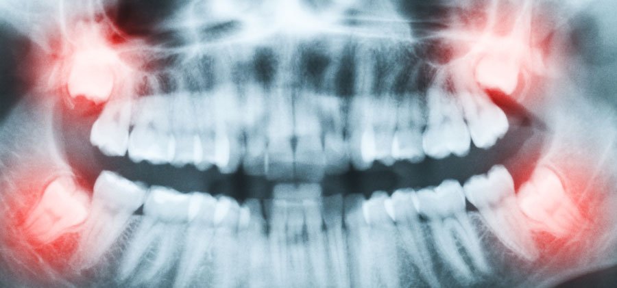 ¿Provocan las muelas del juicio el apiñamiento dental en los incisivos?