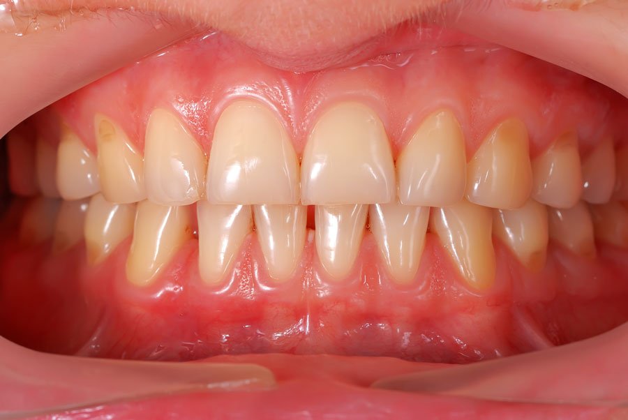 Enfermedad periodontal