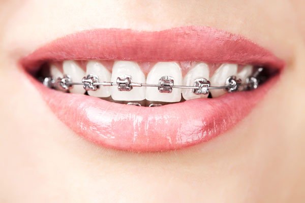 Ortodoncia correctiva
