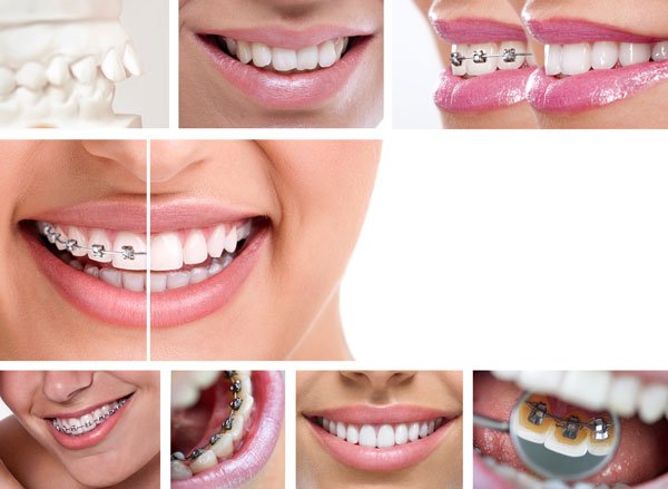 ¿Qué tipos de ortodoncia es mejor?