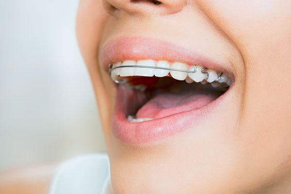 ¿Qué tipos de ortodoncia existen?