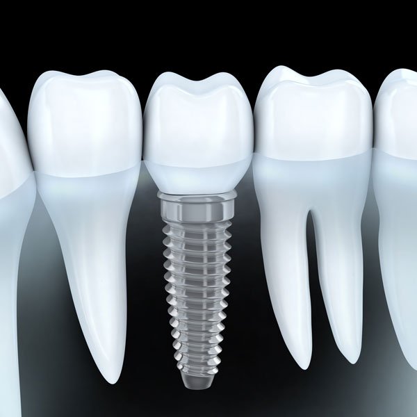 Implantes dentales, ¿Qué puedo hacer después?