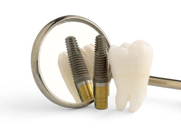 Colocación de un implante dental: recomendaciones