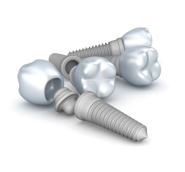 La osteointegración en implantes dentales