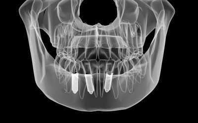 La osteointegración y los implantes dentales