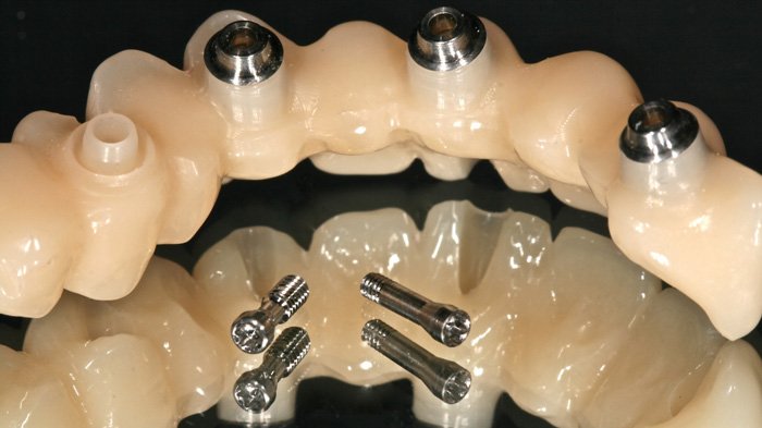 Prótesis dentales sobre implantes dentales