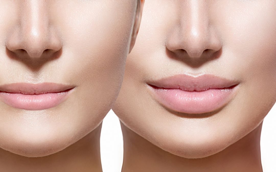Cómo conseguimos resultados naturales con el aumento de labios