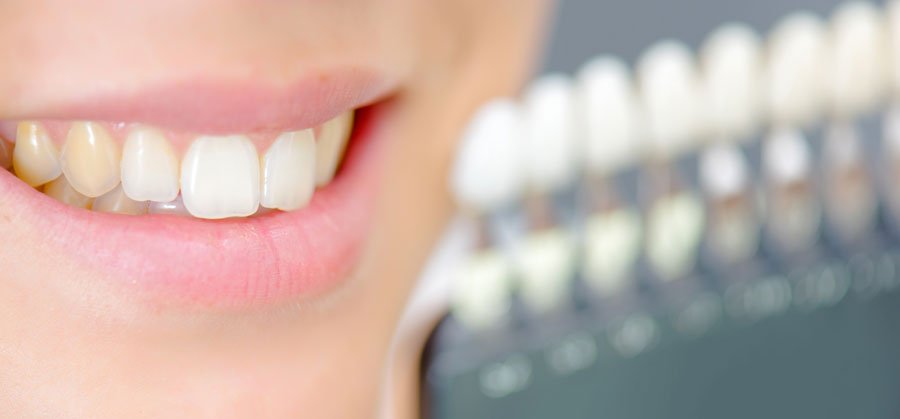 ¿Cuántos tonos aclara blanqueamiento dental?