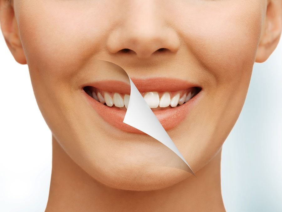 ¿Cuántos tonos aclara el blanqueamiento dental?