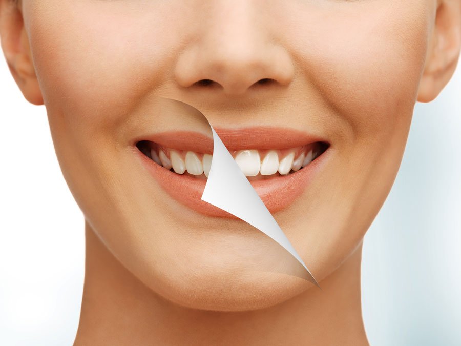 ecuador Soportar Materialismo Cuántos tonos aclara el blanqueamiento dental? - Axioma Estudi Dental
