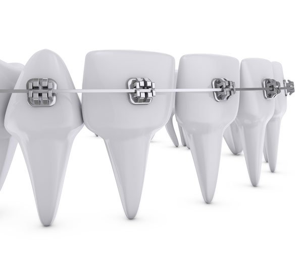 El tiempo y los tratamientos de ortodoncia