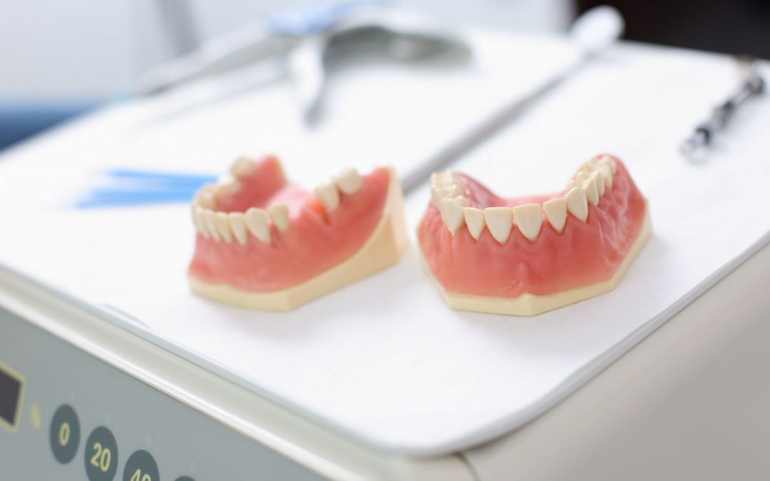 Prótesis dentales: ¿fijas o removibles?