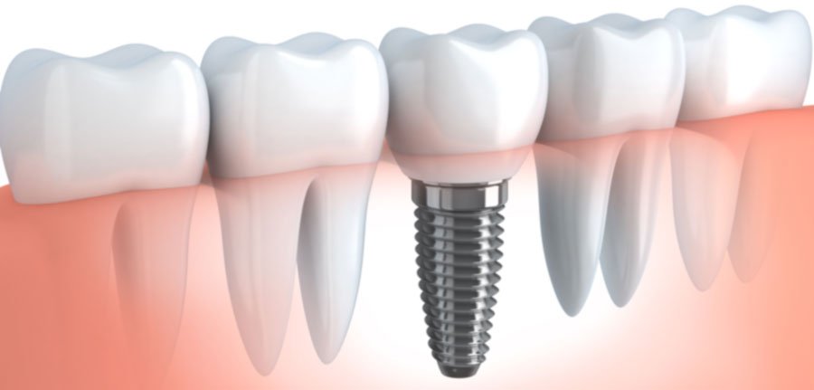 Implante dental hecho de titanio