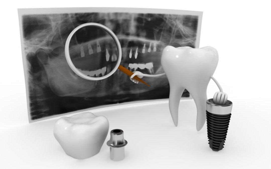 El Titanio: ¿material ideal para los implantes dentales?