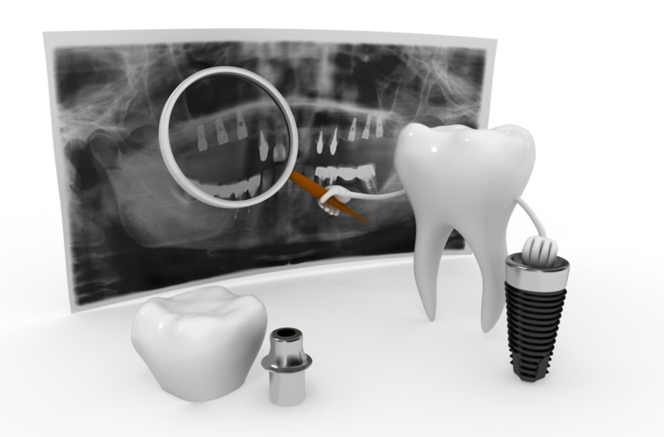¿Para qué sirve un implante dental?