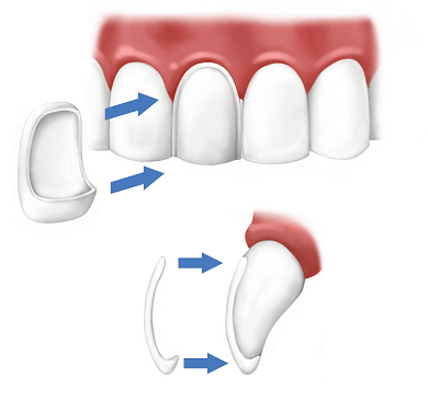 ¿Qué son las carillas dentales?