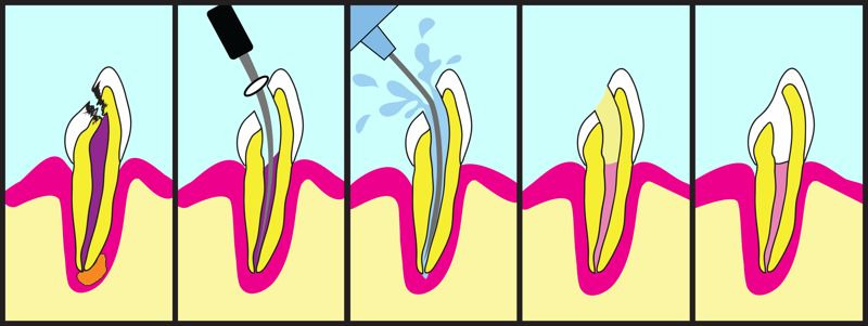 Pasos endodoncia