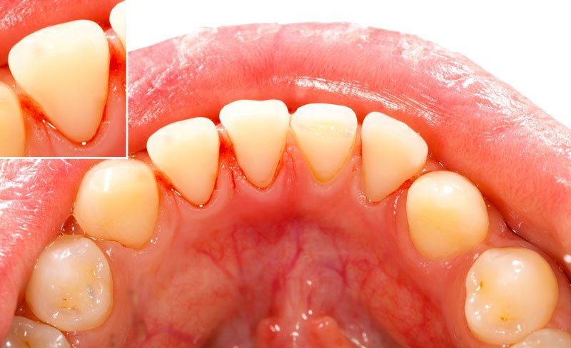 gingivitis clinica dental barcelona