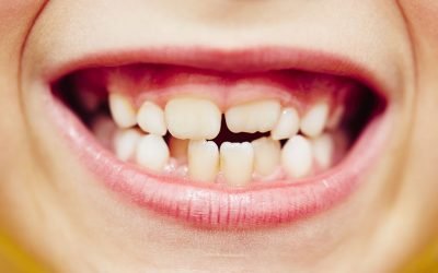 Porqué se produce el apiñamiento dental y como evitarlo