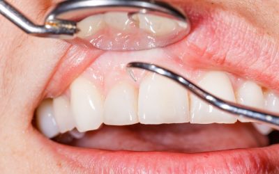 ¿Qué hacer ante una infección dental?