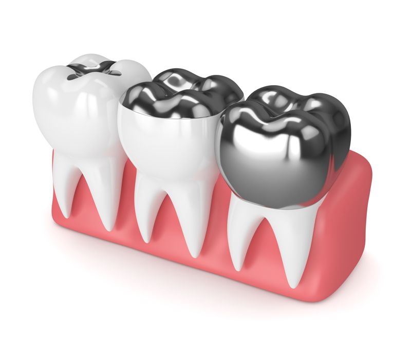 tipos de incrustacion dental