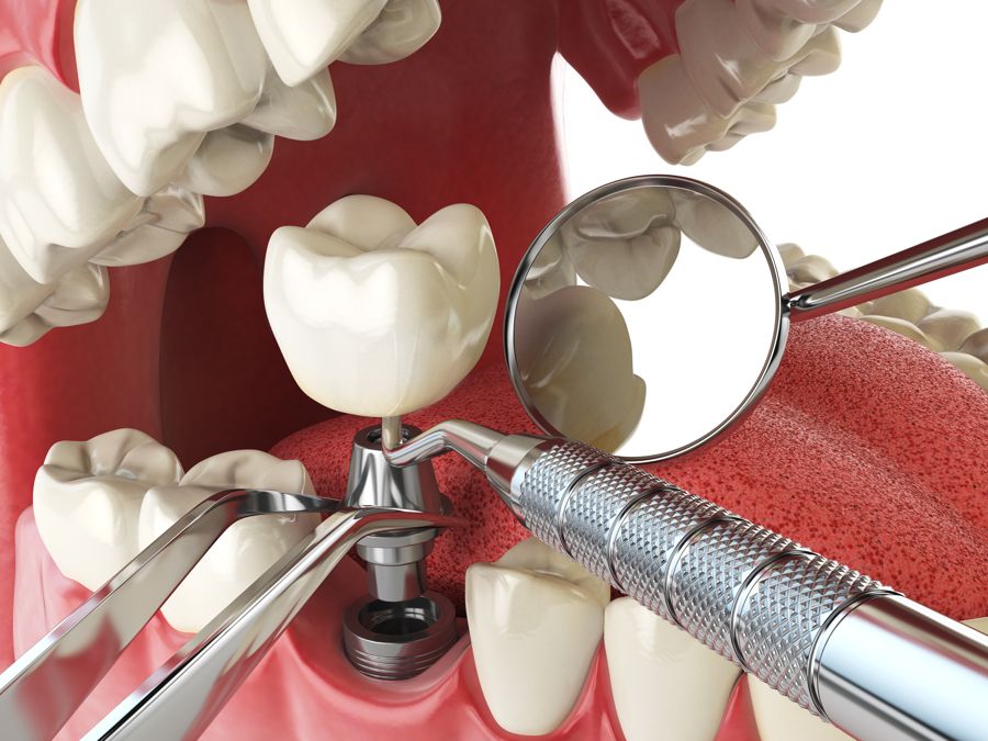 que implantes dentales son mejroes