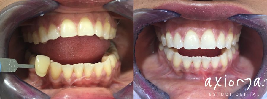 blanqueamiento denta antes y despues Axioma clínica dental en Barcelona