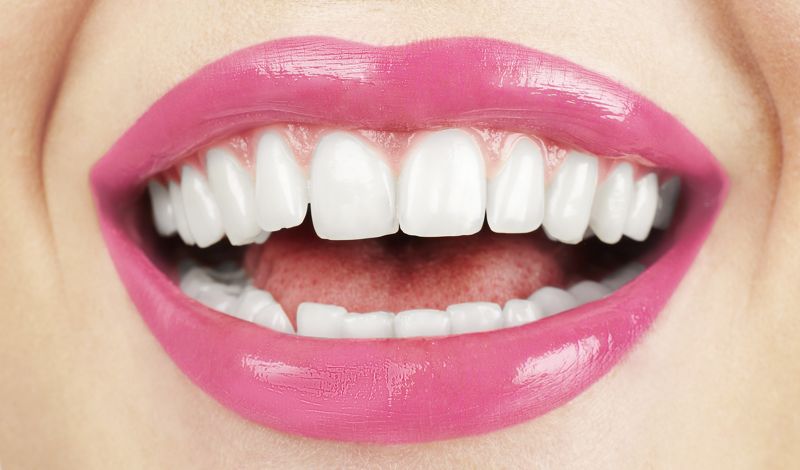  ¿Blanquear mucho los dientes genera adicción?