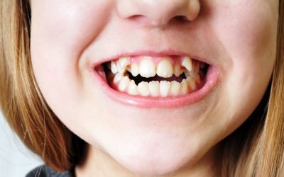 Ortodoncia infantil: Corrección de la mordida cruzada en niños