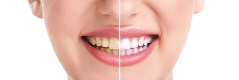 ¿Cuánto tiempo dura el blanqueamiento dental?