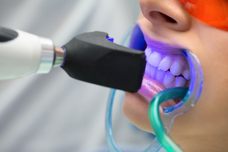 ¿El blanqueamiento dental produce sensibilidad?