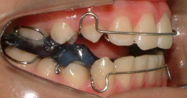 ortodoncia infantil preventiva