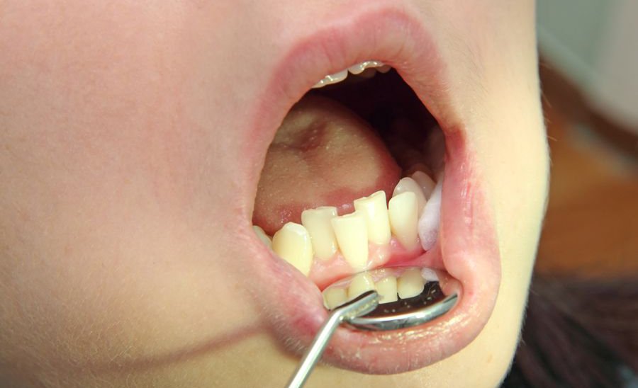 tipos de mordida cruzada en ninos Axioma clínica dental en Barcelona