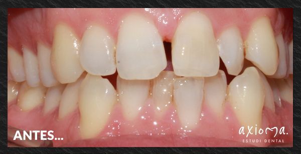 antes y despues invisalign Axioma clínica dental en Barcelona