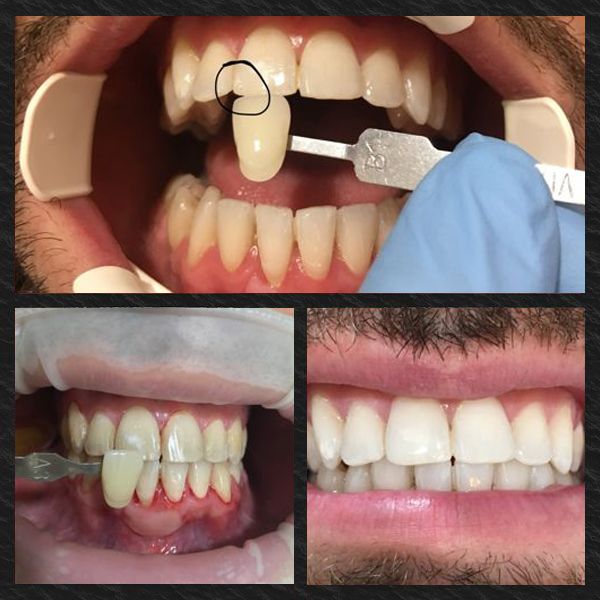 Carillas dentales antes y después