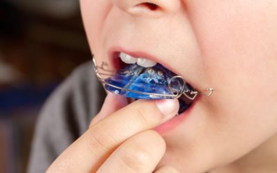 Ortodoncia preventiva en niños: ventajas de un tratamiento temprano