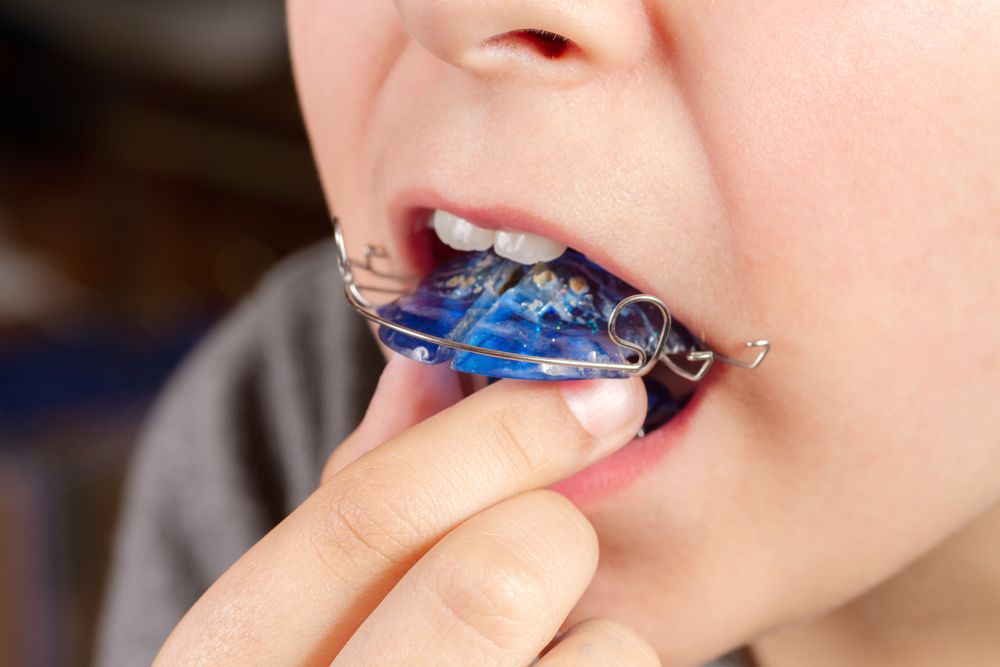 Ortodoncia preventiva en niños: ventajas de un tratamiento temprano