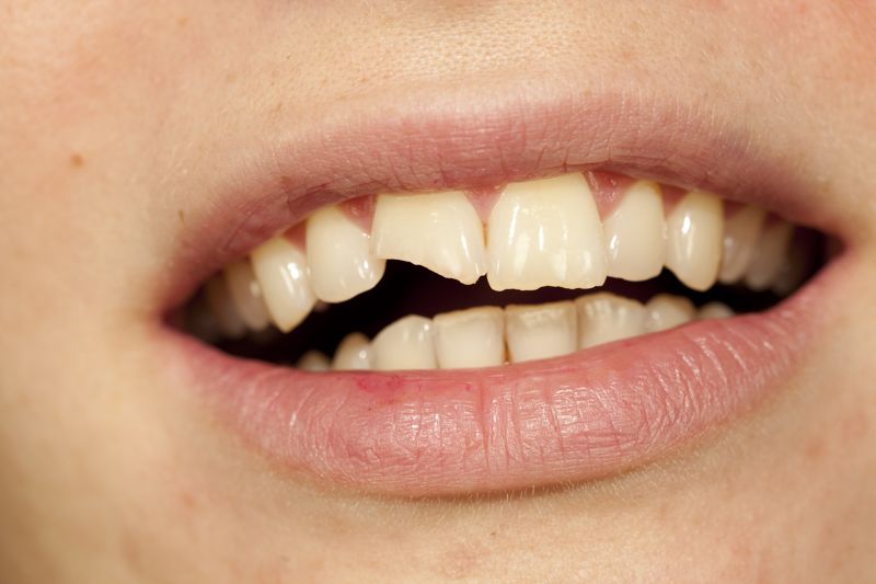 tipos fracturas dentales Axioma clínica dental en Barcelona
